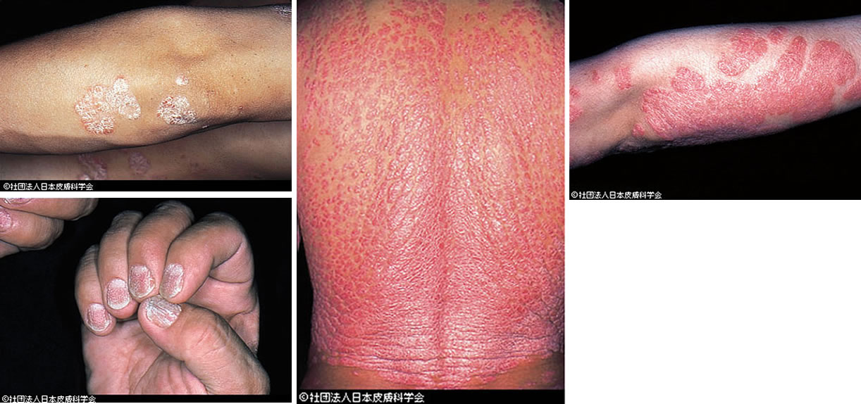 乾癬とは何か、原因、症状、治療法